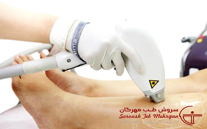 لیزر دایود اپیلیا (Epilia RF Diode Laser)